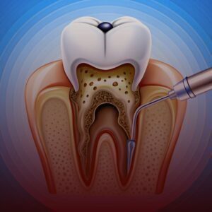 Endodontics in Turkey