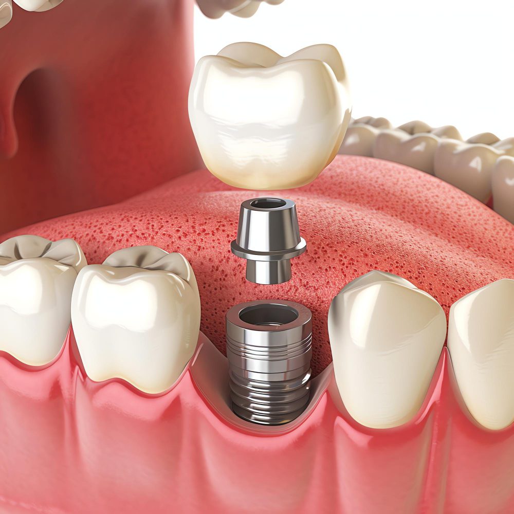 Single-tooth implant procedure at Dr. Abdurrahman Ozturk in Turkey, Istanbul