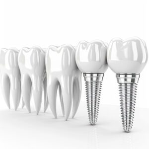 Implantes Dentales con Técnica All-on-4