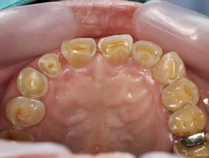 علاج ذوبان الأسنان